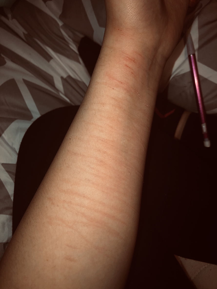 Close-up of human forearm with visible skin texture and faint red marks, Hand cutpinterest.ph, #hand cut HD phone wallpaper