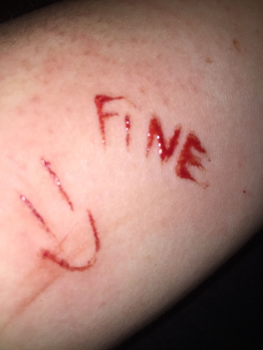 Emotional Self-Harm Scar Artwork With The Word Fine Inscribed On Skin HD phone wallpaper